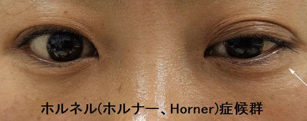 内視鏡的甲状腺手術(ETS)後のホルネル(ホルナー、Horner)症候群 内視鏡的甲状腺手術(ETS)後のホルネル(ホルナー、Horner)症候群