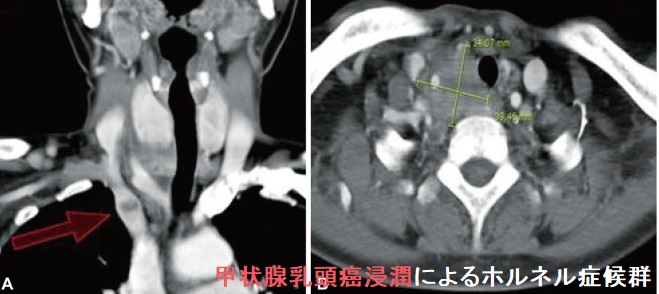 甲状腺乳頭癌浸潤によるホルネル(ホルナー、Horner)症候群 甲状腺乳頭癌浸潤によるホルネル(ホルナー、Horner)症候群1