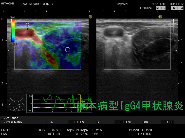 橋本病型IgG4甲状腺炎 エラストグラフィー2 橋本病型IgG4甲状腺炎 エラストグラフィー2