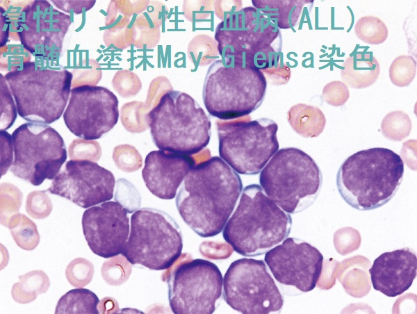 急性リンパ性白血病(急性リンパ芽球性白血病、ALL)骨髄血塗抹May-Giemsa染色 急性リンパ性白血病(急性リンパ芽球性白血病、ALL)骨髄血塗抹May-Giemsa染色