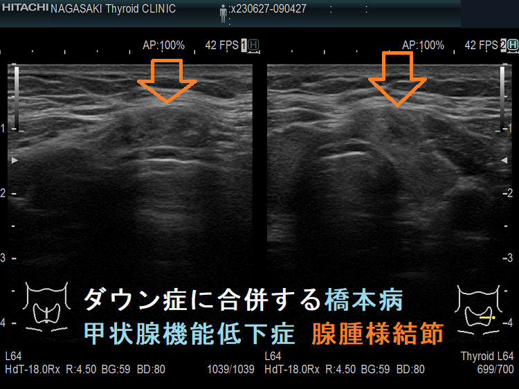 ダウン症に合併する橋本病 甲状腺機能低下症 腺腫様結節 ダウン症に合併する橋本病 甲状腺機能低下症 腺腫様結節
