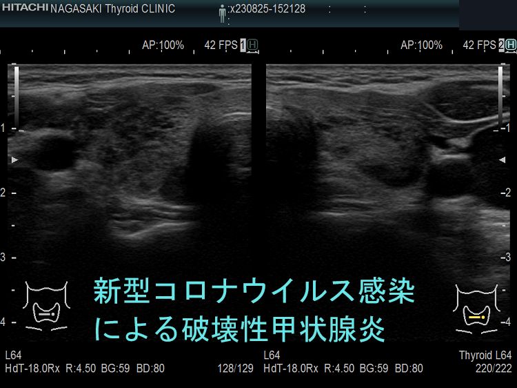 新型コロナウイルス感染(COVID-19)による破壊性甲状腺炎 新型コロナウイルス感染(COVID-19)による破壊性甲状腺炎