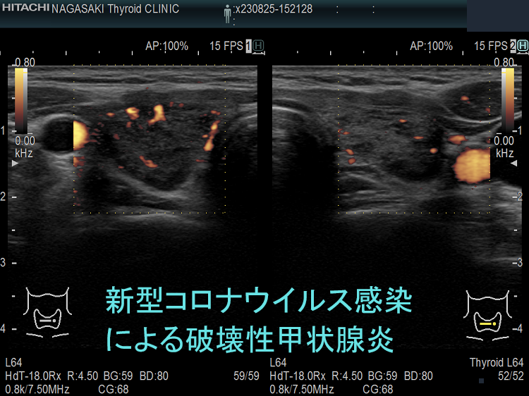 新型コロナウイルス感染(COVID-19)による破壊性甲状腺炎 ドプラーモード 新型コロナウイルス感染(COVID-19)による破壊性甲状腺炎 ドプラーモード