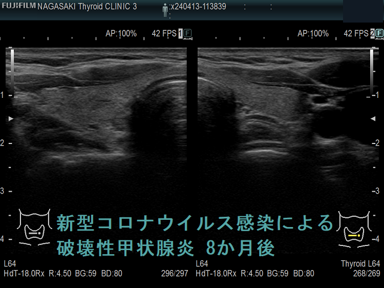 新型コロナウイルス感染(COVID-19)による破壊性甲状腺炎 8か月後 新型コロナウイルス感染(COVID-19)による破壊性甲状腺炎 8か月後