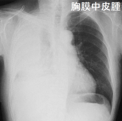 胸膜中皮腫 胸部エックス線写真 胸膜中皮腫 胸部エックス線写真
