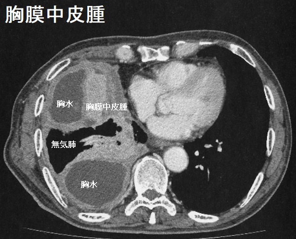 胸膜中皮腫 胸部造影CT 胸膜中皮腫 胸部造影CT