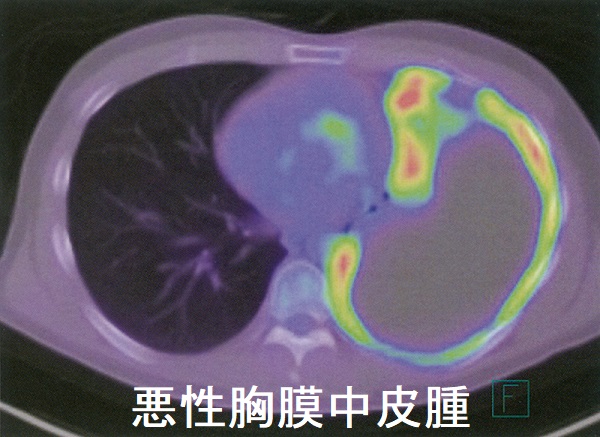 悪性胸膜中皮腫 PET/CT画像 悪性胸膜中皮腫 PET/CT画像
