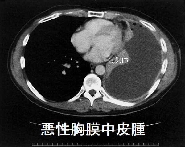 悪性胸膜中皮腫 CT画像 悪性胸膜中皮腫 CT画像