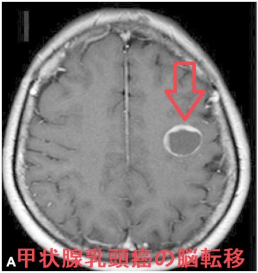 甲状腺乳頭癌の脳転移 甲状腺乳頭癌の脳転移