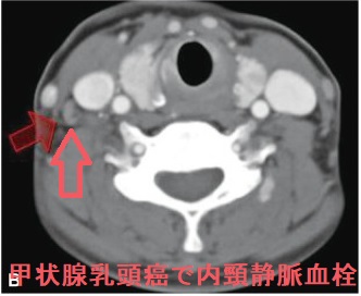甲状腺乳頭がんで内頸静脈血栓 甲状腺乳頭がんで内頸静脈血栓