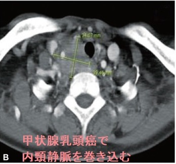 甲状腺乳頭癌で内頸静脈を巻き込む 甲状腺乳頭癌で内頸静脈を巻き込む