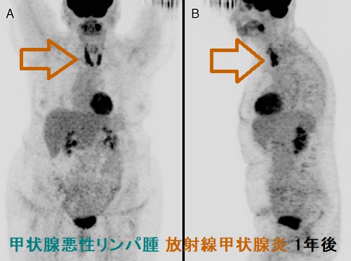 甲状腺原発悪性リンパ腫 放射線甲状腺炎 1年後 甲状腺原発悪性リンパ腫 放射線甲状腺炎 1年後
