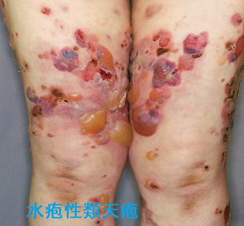 水疱性類天疱瘡 水疱性類天疱瘡