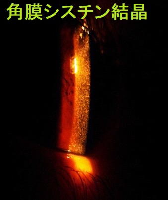 ‎角膜シスチン結晶 角膜シスチン沈着物の細隙灯検査 ‎角膜シスチン結晶 角膜シスチン沈着物の細隙灯検査