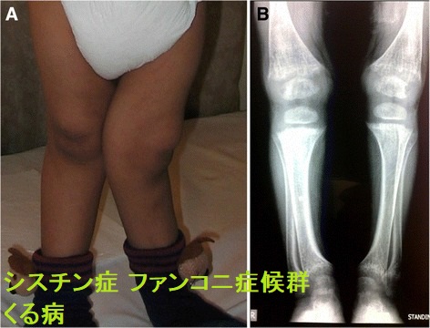 シスチン症 ファンコニ症候群 くる病 シスチン症 ファンコニ症候群 くる病
