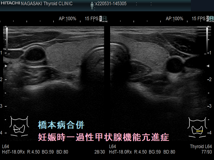 橋本病合併妊娠時一過性甲状腺機能亢進症の超音波(エコー)画像 橋本病合併妊娠時一過性甲状腺機能亢進症の超音波(エコー)画像