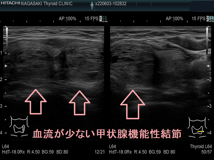 血流が少ない甲状腺機能性結節) 超音波(エコー)画像 血流が少ない甲状腺機能性結節) 超音波(エコー)画像