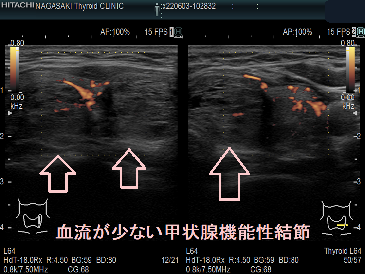 血流が少ない甲状腺機能性結節 ) 超音波(エコー)画像 ドプラーモード 血流が少ない甲状腺機能性結節 ) 超音波(エコー)画像 ドプラーモード