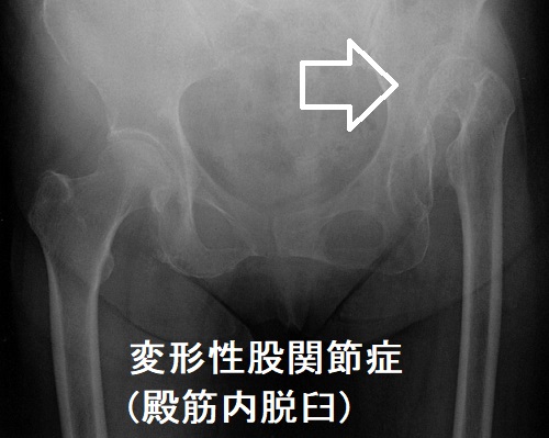 変形性股関節症(殿筋内脱臼) 変形性股関節症(殿筋内脱臼)