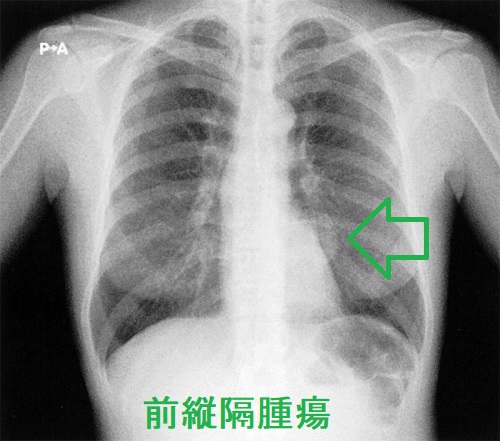 前縦隔腫瘍 胸部単純レントゲン写真 前縦隔腫瘍 胸部単純レントゲン写真