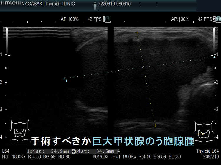 手術すべきか巨大甲状腺のう胞腺腫 手術すべきか巨大甲状腺のう胞腺腫