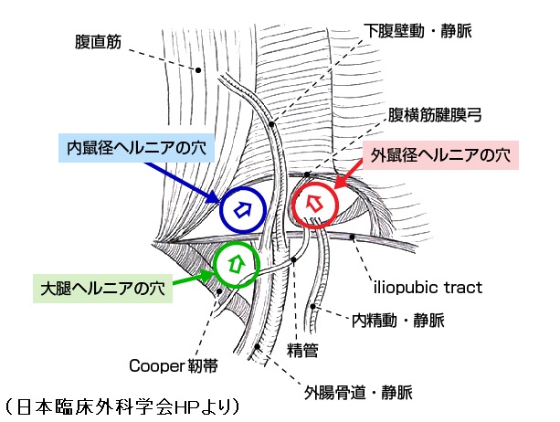 鼠径(そけい)ヘルニア(脱腸) 鼠径(そけい)ヘルニア(脱腸)