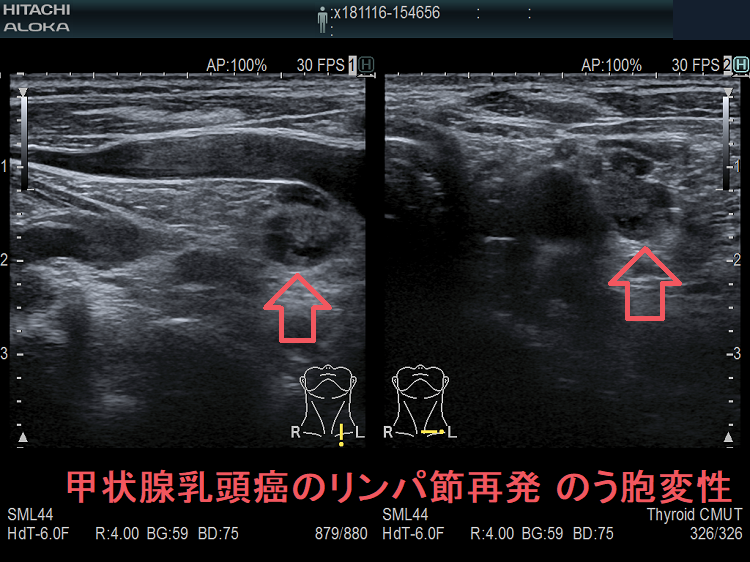 甲状腺乳頭癌の左鎖骨上窩 リンパ節再発 のう胞変性 超音波(エコー)画像 甲状腺乳頭癌の左鎖骨上窩 リンパ節再発 のう胞変性 超音波(エコー)画像