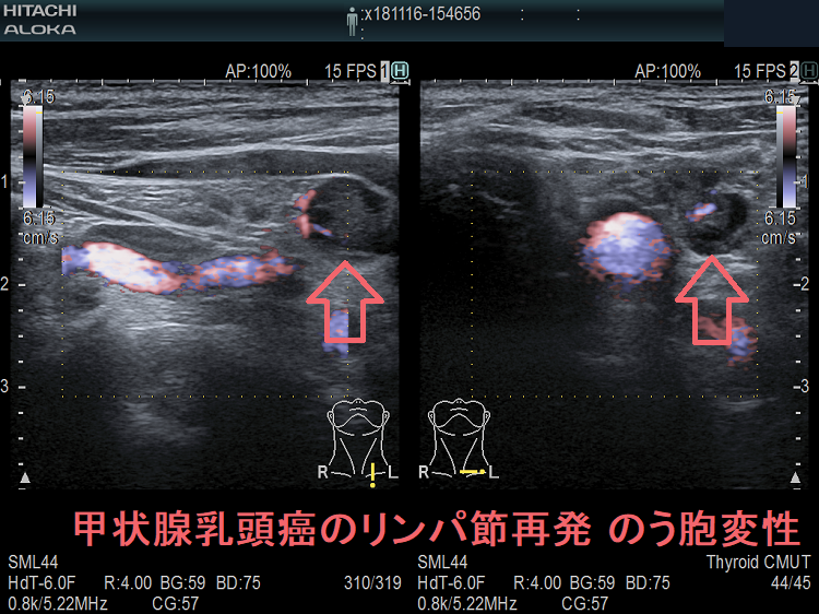 甲状腺乳頭癌の左鎖骨上窩 リンパ節再発 のう胞変性 超音波(エコー)画像ドプラーモード 甲状腺乳頭癌の左鎖骨上窩 リンパ節再発 のう胞変性 超音波(エコー)画像ドプラーモード