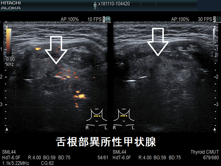 舌根部異所性甲状腺 ドプラーモード 舌根部異所性甲状腺 ドプラーモード