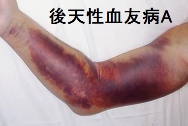 後天性血友病A 後天性血友病A