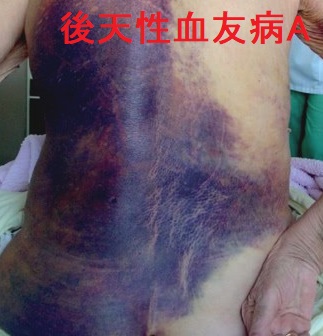 後天性血友病A 後天性血友病A