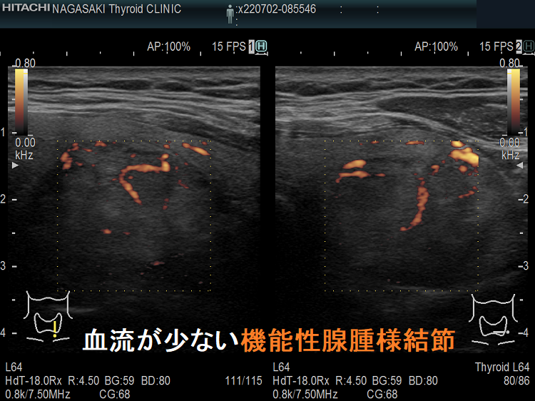 血流が少ない機能性腺腫様結節 血流が少ない機能性腺腫様結節