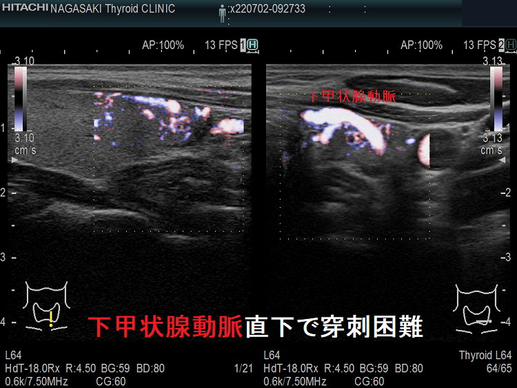 下甲状腺動脈直下で穿刺困難の小さな腫瘤 ドプラーモード 下甲状腺動脈直下で穿刺困難の小さな腫瘤 ドプラーモード