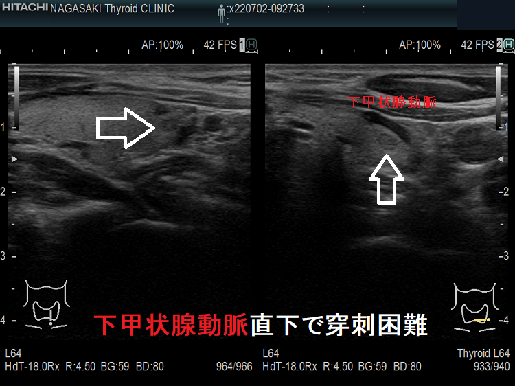 下甲状腺動脈直下で穿刺困難の小さな甲状腺腫瘍 下甲状腺動脈直下で穿刺困難の小さな甲状腺腫瘍