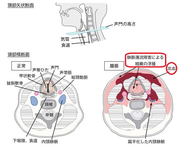 甲状腺摘出後喉頭浮腫のメカニズム 甲状腺摘出後喉頭浮腫のメカニズム