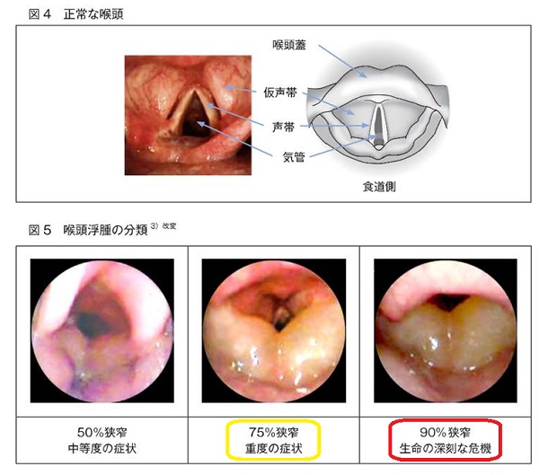甲状腺摘出後喉頭浮腫 甲状腺摘出後喉頭浮腫
