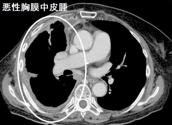 悪性胸膜中皮腫 CT画像 悪性胸膜中皮腫 CT画像