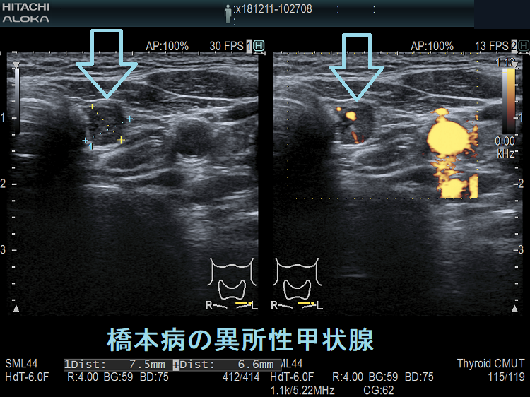 橋本病の異所性甲状腺 超音波(エコー)画像 橋本病の異所性甲状腺 超音波(エコー)画像