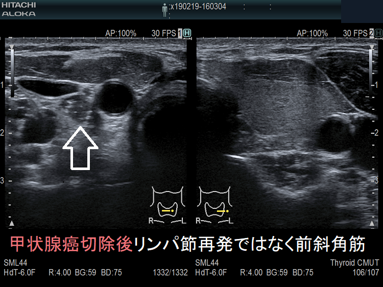 甲状腺癌半葉切除後リンパ節再発ではなく前斜角筋 超音波(エコー)画像 甲状腺癌半葉切除後リンパ節再発ではなく前斜角筋 超音波(エコー)画像