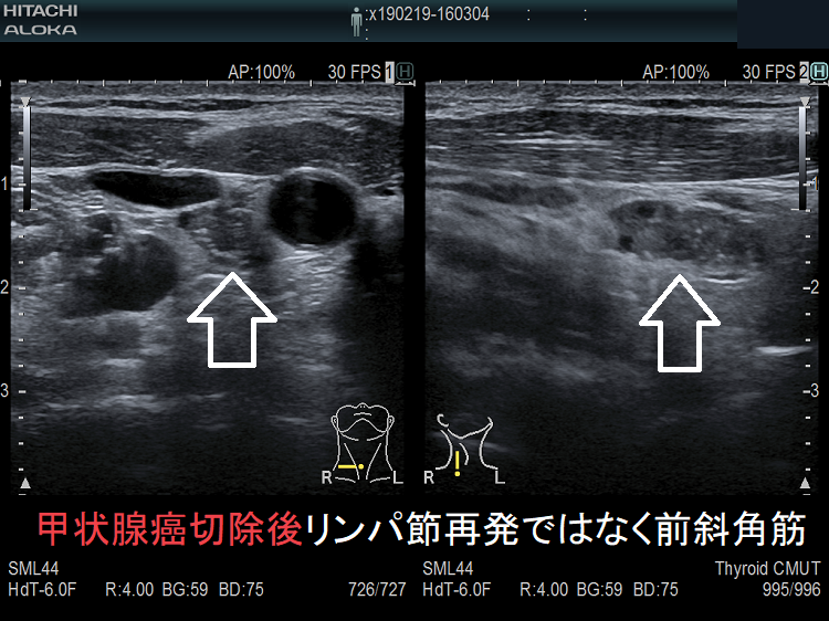 甲状腺癌半葉切除後リンパ節再発ではなく前斜角筋 超音波(エコー)画像 甲状腺癌半葉切除後リンパ節再発ではなく前斜角筋 超音波(エコー)画像