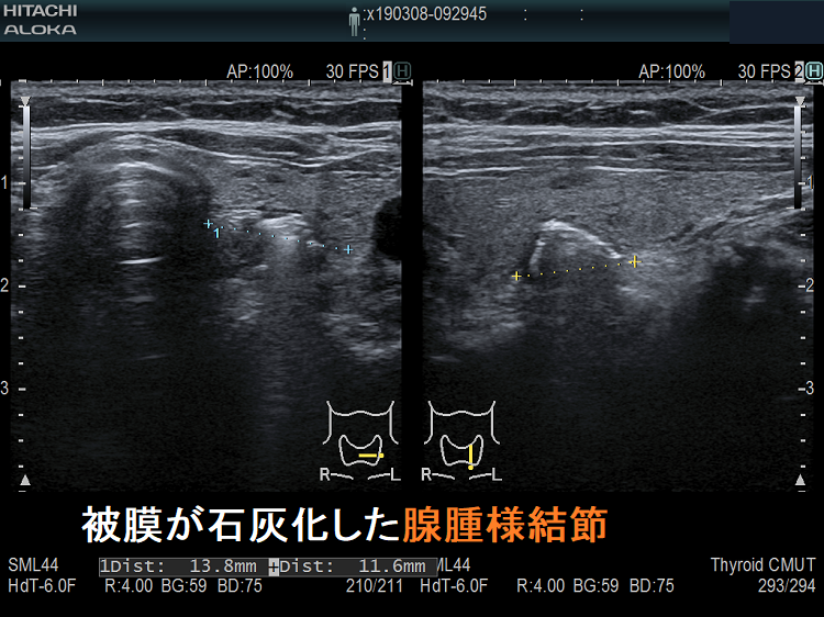 被膜が石灰化した腺腫様結節 被膜が石灰化した腺腫様結節
