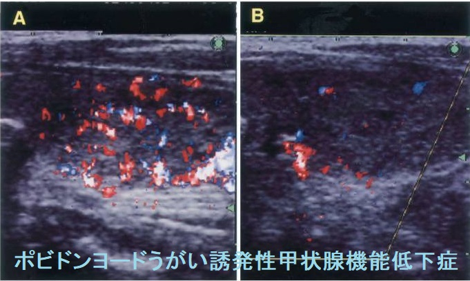 ポビドンヨードうがい誘発性甲状腺機能低下症 ポビドンヨードうがい誘発性甲状腺機能低下症