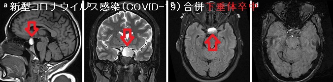 新型コロナウイルス感染(COVID-19)による下垂体卒中 新型コロナウイルス感染(COVID-19)による下垂体卒中