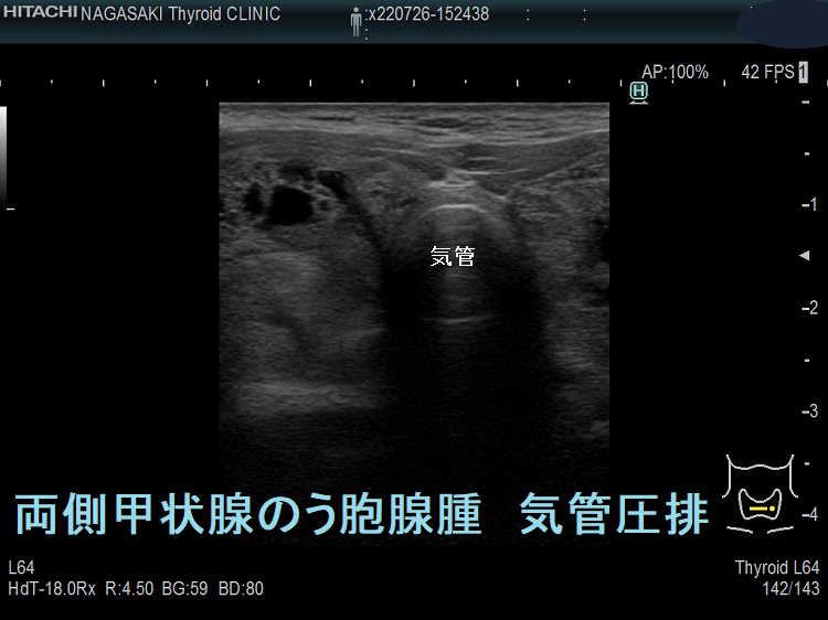 両側甲状腺のう胞腺腫 気管圧排 両側甲状腺のう胞腺腫 気管圧排