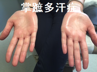 掌蹠多汗症 掌蹠多汗症