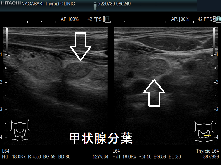 甲状腺分葉 超音波(エコー)画像 甲状腺分葉 超音波(エコー)画像