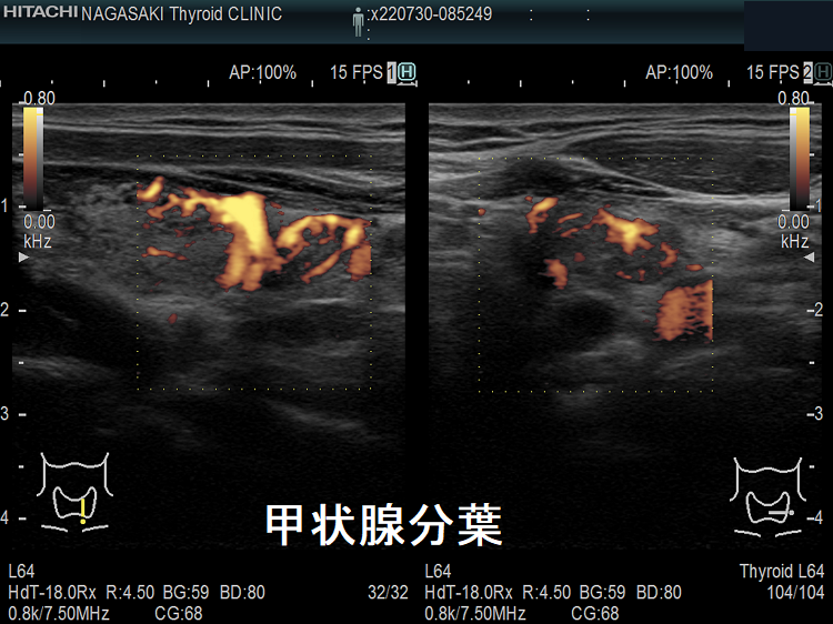 甲状腺分葉 超音波(エコー)画像 ドプラーモード 甲状腺分葉 超音波(エコー)画像 ドプラーモード