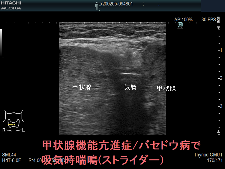 甲状腺機能亢進症/バセドウ病の巨大甲状腺腫による上気道狭窄で吸気時喘鳴(ストライダー) 甲状腺機能亢進症/バセドウ病の巨大甲状腺腫による上気道狭窄で吸気時喘鳴(ストライダー)