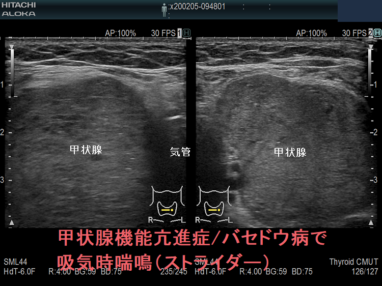 甲状腺機能亢進症 バセドウ病で吸気時喘鳴(ストライダー)2 甲状腺機能亢進症 バセドウ病で吸気時喘鳴(ストライダー)2