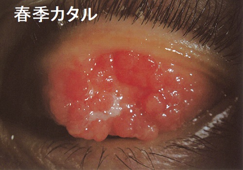 春季カタル 春季カタル